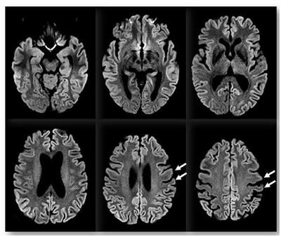 Report of a Case of Creutzfeldt-Jakob Disease With an Unusual Clinical Presentation